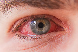 Pink Eye (Conjunctivitis)